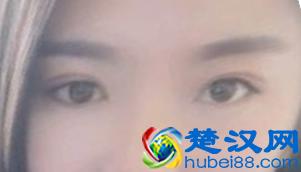  什么是义眼台（义眼台什么材料最好）