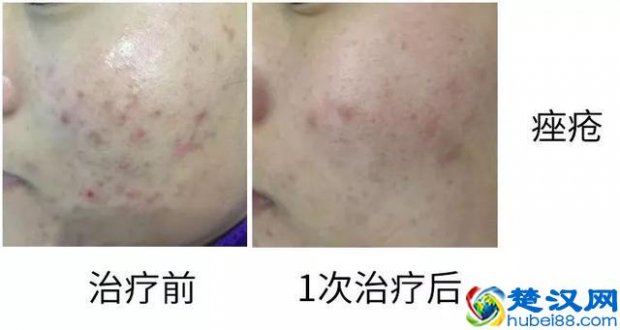  果酸换肤是什么原理（大揭秘：果酸换肤适合什么皮肤，有何效果）