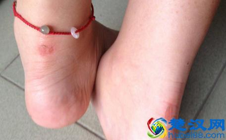  新买的鞋子磨脚怎么处理（如何解决鞋子磨脚问题）