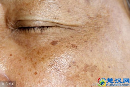  脸上老年斑怎么去除？食疗的两个方法效果最佳