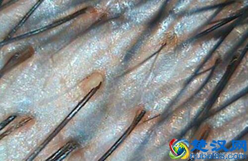  怎么治疗脂溢性脱发最有效？根治永久不再犯