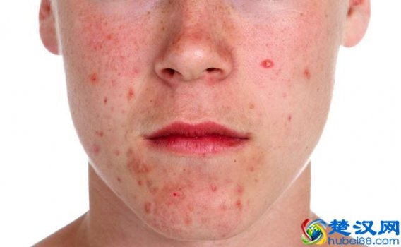  得了痤疮怎么办？治理痤疮的妙招