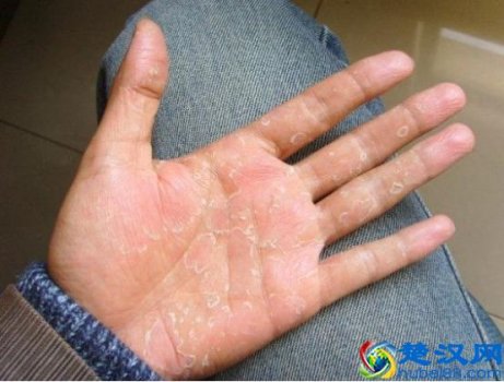  鹅掌风怎么治？民间偏方有奇效