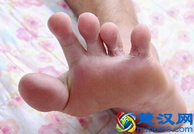  脚气怎么根治最简单有效的土方法，省钱又省事