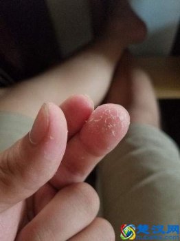  手上有502胶水怎么洗掉？万能的小妙招，赶紧试试