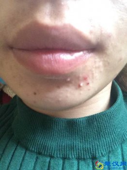  下巴长痘痘是什么原因（教你几招调理好身体）