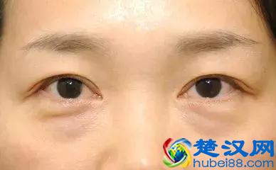  黑眼袋黑眼圈怎么消除（面部潮红的根治方法）