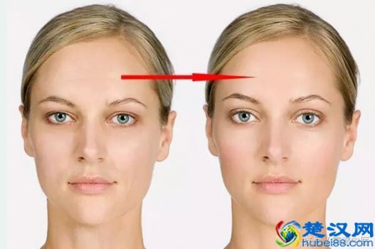  怎样去掉抬头纹（抬头纹去除方法）