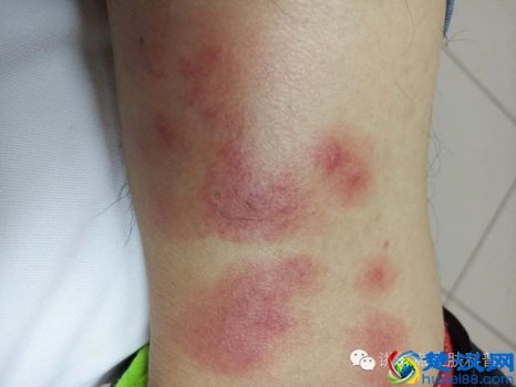  臭虫咬的症状（被臭虫叮咬是一种什么样的感受）