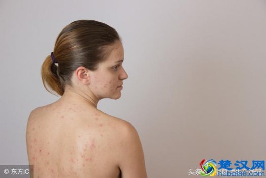  背后长痘痘是什么原因（对应的解决方案是什么）