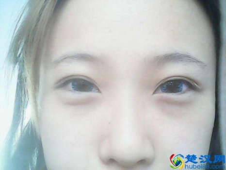  怎样除眼袋效果好（教你几个实用好办法，轻松解决）