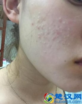  闭口粉刺是怎么形成的(闭口粉刺怎么消除不留印）