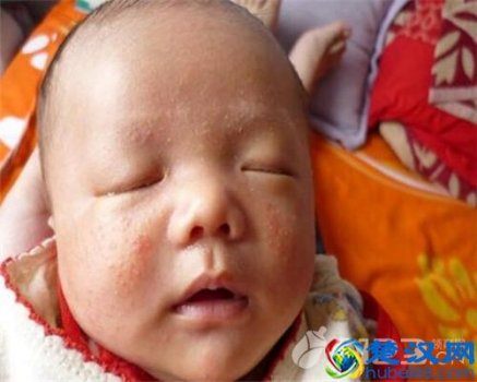  婴儿湿疹的原因有哪些，以及有哪些治疗方法！
