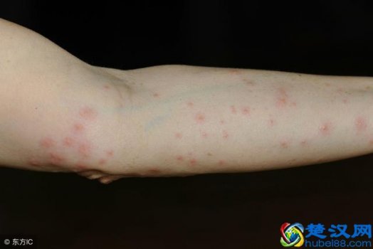  皮肤过敏怎么办？预防以及解决方法