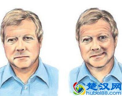  什么叫面瘫（面瘫什么症状）