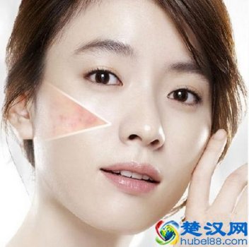  要怎么去除脸上的痘印（两颊痘印去的很慢）