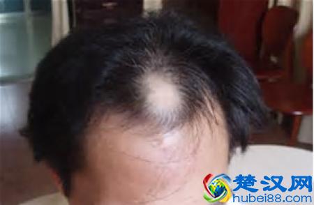  头油头痒头屑多怎么办（怎么确认头发上有头螨）