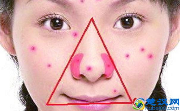 超级细菌！浙江一男生手贱挤了个痘子，不幸感染超级细菌，生命垂危