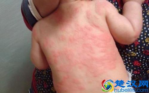 宝宝得了湿疹怎么办？五种快速有效治疗方案（宝妈必备）