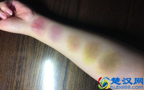淤青怎么快速消除的方法？这样去淤青好的快，不留痕